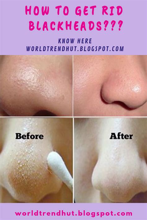 Know How To Get Rid Of Blackheads With Less Effort Get Rid Of