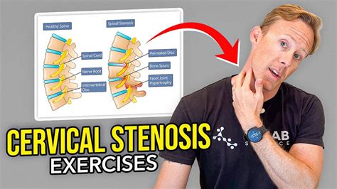 5 Exercises For Cervical Stenosis Arm Nerve Pain Youtube
