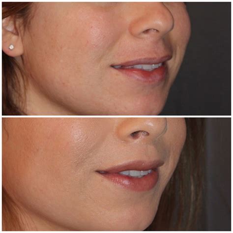 35 year old female 3 months following an upper modified lip lift kalos facial plastic surgery