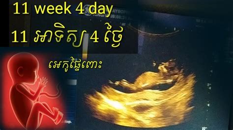 ពិនិត្យអេកូផ្ទៃពោះ 11អាទិត្យ 4ថ្ងៃ Pregnancy Ultrasound 11 Week 4 Day