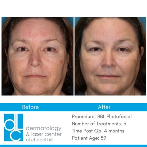 Bbl Laser Before And After 1 Treatment Photofacial Ipl Treatment
