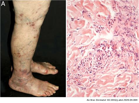 Update On Vasculitis Overview And Relevant Dermatological Aspects For