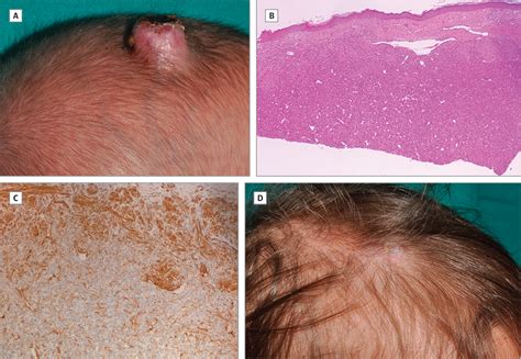 Spontaneous Regression Of An Infantile Scalp Tumor Dermatology Jama