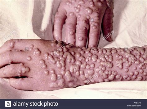 Monkeypox is a viral disease that causes symptoms such as fever, sweating, and a rash with papules and pustules on the face and chest. Pocken Variola Virus nach 10 Tagen Stockfoto, Bild ...