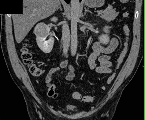 Renal Cell Carcinoma Right Kidney On Multiple Phases Kidney Case