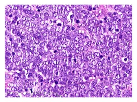 Histological Immunohistological And Clinical Features Of Merkel Cell