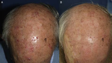 Man With Multiple Actinic Keratoses And Field Cancerization On The