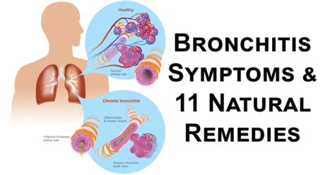 Bronchitis Symptoms And 11 Natural Remedies David Avocado Wolfe