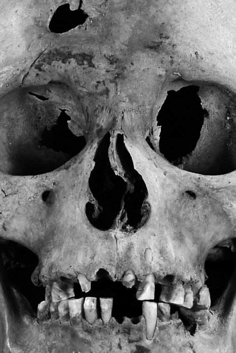 Trepanning Hole Skull Skull Reference Skull And Bones