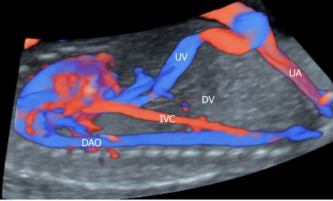 Fetal Ductus Venosus