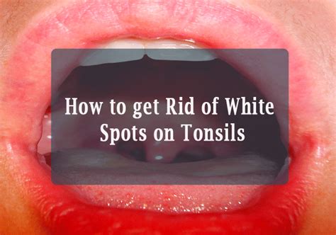 How To Get Rid Of White Spots On Tonsils