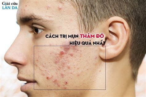 Cách Trị Mụn Thâm đỏ Tại Nhà Cách Trị Mụn Thâm đỏ Tại Nhà Hiệu Quả Và