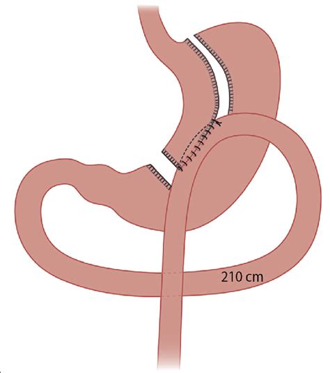 Illustration Of The One Anastomosis Gastric Bypass Technique Download