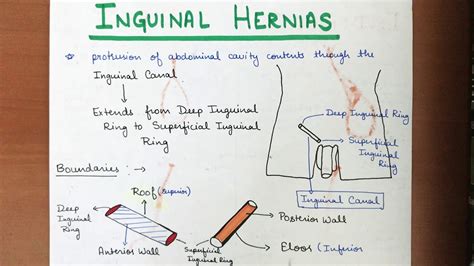 Direct inguinal hernias protrude anteromedial and inferior to the course of the inferior epigastric vessels, whereas indirect inguinal hernias protrude posterolateral and superior to the course of those vessels. Inguinal Hernia's - Indirect and Direct Types - Part 1 ...