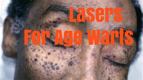 Lasers For Age Warts And Pigmentation Warts Laser Antiaging