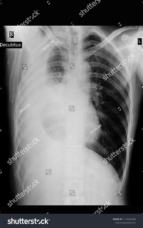 Chest Xray Decubitus Show Infiltration Right Foto Stock