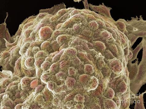 Prostate Cancer Cells Photograph By Anne Weston Francis Crick