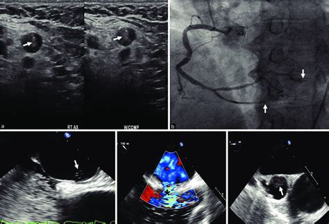 A Doppler Ultrasound Of Axillary Vein Showing A Thrombus B Right