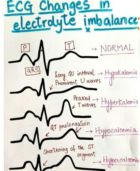 Ecg Changes Due To Electrolyte Imbalance Electrolyte Disorder Ecg