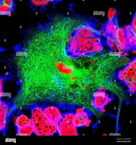 Neuroblastoma Cells Fluorescence Light Micrograph Of Cells From A Type