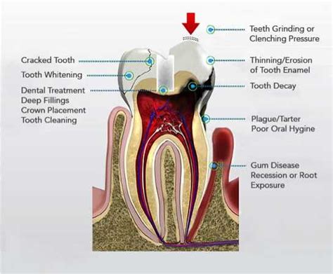 What Are The Causes Treatments And Remedies For Tooth Sensitivity