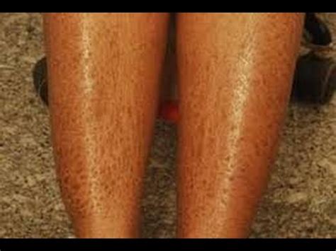 We have information and answer to including causes including on legs, armpits, genitals, breasts, around lips, nose, and on the baby. How to Heal Dry Skin on Legs - YouTube