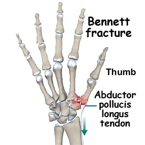 Bennett fracture causes, symptoms, diagnosis, treatment ...