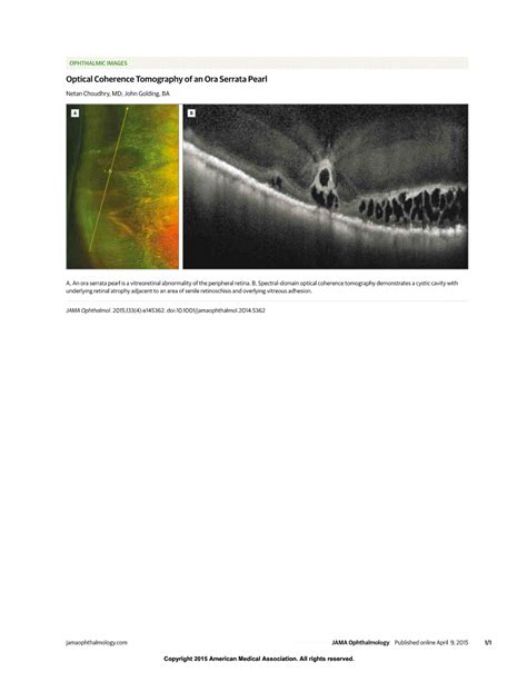Optical Coherence Tomography Of An Ora Serrata Pearl