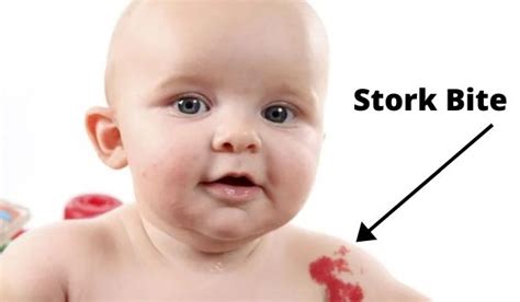 Stork Bite Vs Hemangioma Baby Rashes