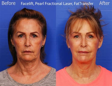 laser treatments san diego — sky facial plastic surgery