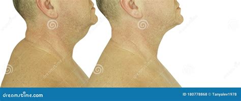 Male Double Chin Before And After Treatment Facelift Removal Stock