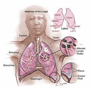 CANCER MALAYSIA: Lung Cancer - Classification, Stages, Symptoms, Causes, Effects, Prevention ... Lung Cancer  