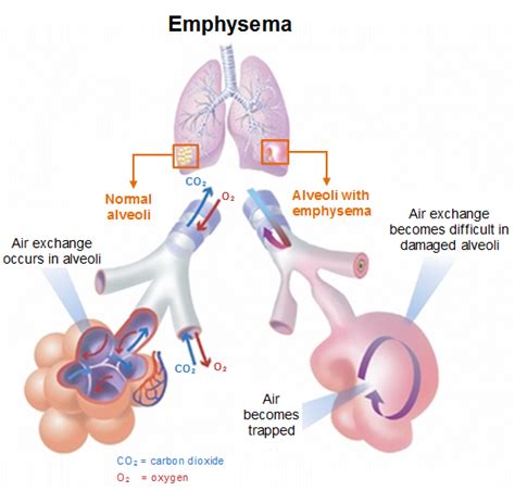 It gets worse over time, and a range of factors can affect how quickly it progresses. eDucate | Chronic obstructive pulmonary disease (COPD)