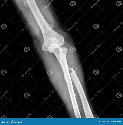 X Ray Of Broken Arm Stock Photo Image 47700503