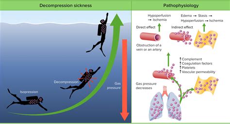 Decompression Sickness Concise Medical Knowledge