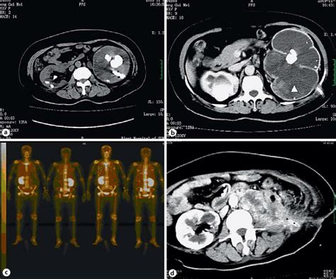 Perioperative Images A Ct Showing Bilateral Nephrolithiasis Three