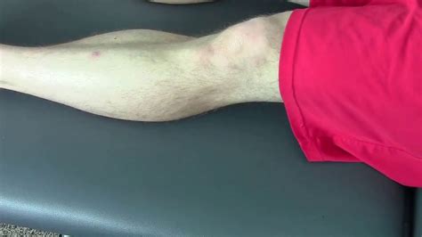 Knee Pain Hyperextension Treatemt Part 1 Youtube