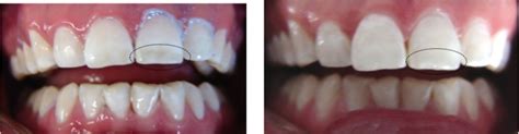 The Dental Advantage Fluorosis Dental Y Sus Tratamientos