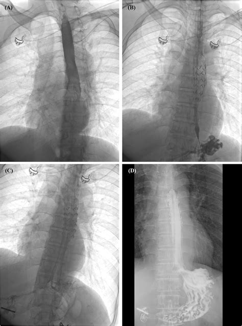 Frontiers Compression Hemostasis Using Fully Covered Self Expandable