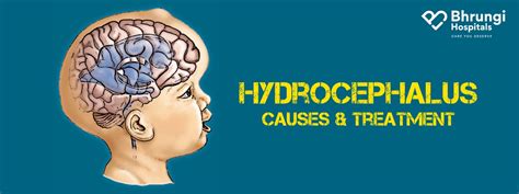 Hydrocephalus Causes And Treatment Bhrungi Hospitals