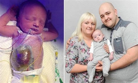 How to get third stimulus check for baby born in 2020. Parents' relief as baby born with bowel on the OUTSIDE of ...