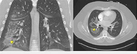 Ct Chest Showing Bibasilar Airspace Opacities Predominantly