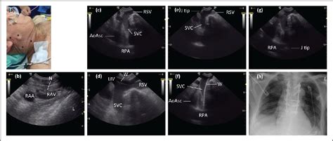 Figure 1 From The Value Of Real Time Ultrasound Guidance For Definite