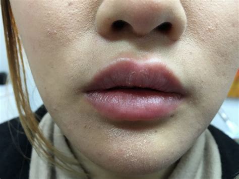 Lip Fillers Sydney Au My Cosmetic Clinic