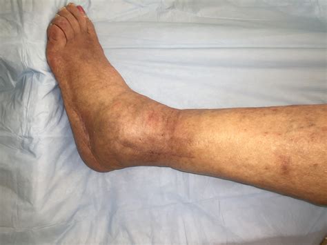 Managing A Radiographically Simple Ankle Fracture In A Complex Patient