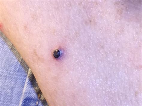 Blood Blister Or Something Else On My Moms Arm Its Not Very Big