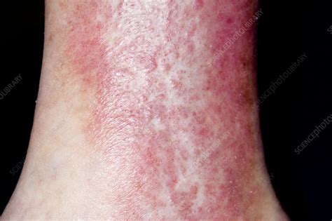 Treated Varicose Eczema Stock Image C0130854 Science Photo Library