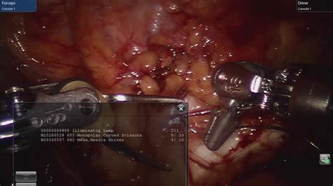Robotic Direct Inguinal Hernia Repair Youtube