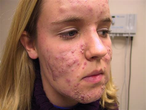 Acne Type Medical Pictures Info Health Definitions Photos