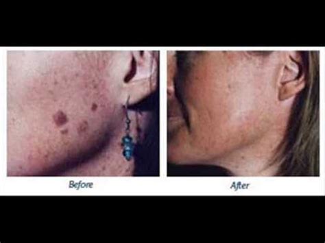 If you see a mole in your home, your best option is contacting. how can you remove moles - YouTube